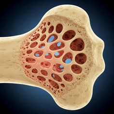 Ankylosing Spondylitis