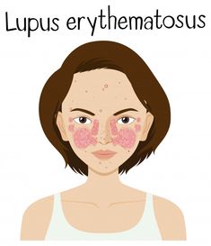Antiphospholipid Syndrome