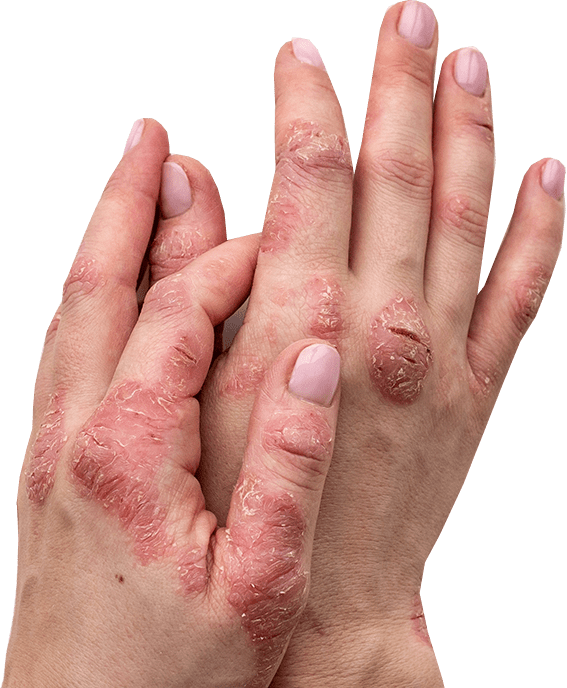 Osteoarthritis