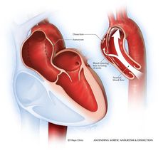 Polymyositis