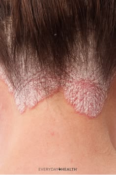 SLE (Lupus)